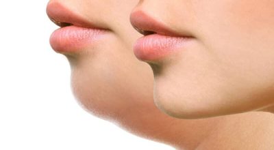 Mulher-com-e-sem-papada-800x450-2